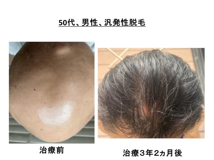 円形脱毛症　病院